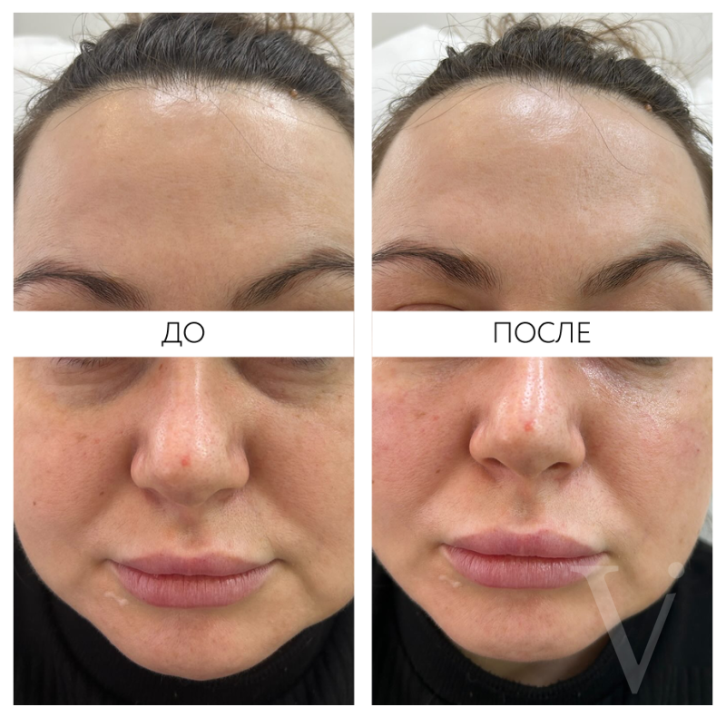 Сферогель – результат до и после. Фото 770. Доктор Наталья Шукюрова. Отзыв о препарате Сферогель