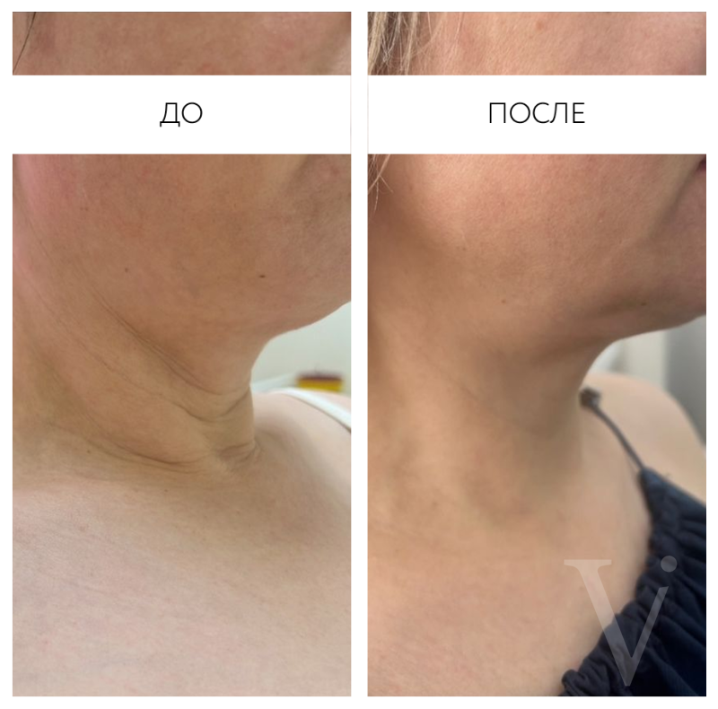 Сферогель – результат до и после. Фото 769. Доктор Наталья Шукюрова. Отзыв о препарате Сферогель